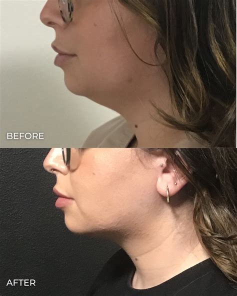 coolsculpting chin brisbane|Best Coolsculpting Treatment in Australia .
